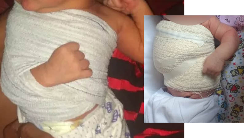 BebÃªs sofrem lesÃµes na clavÃ­cula durante partos em hospitais de Campo Grande